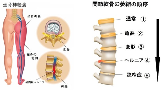 瞹椎椎間板ヘルニア腰椎脊柱管狭窄症坐骨神経 ヨガバックストレッチャー 行き過ぎ